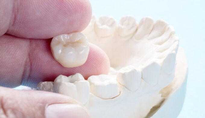 what-are-dental-crowns